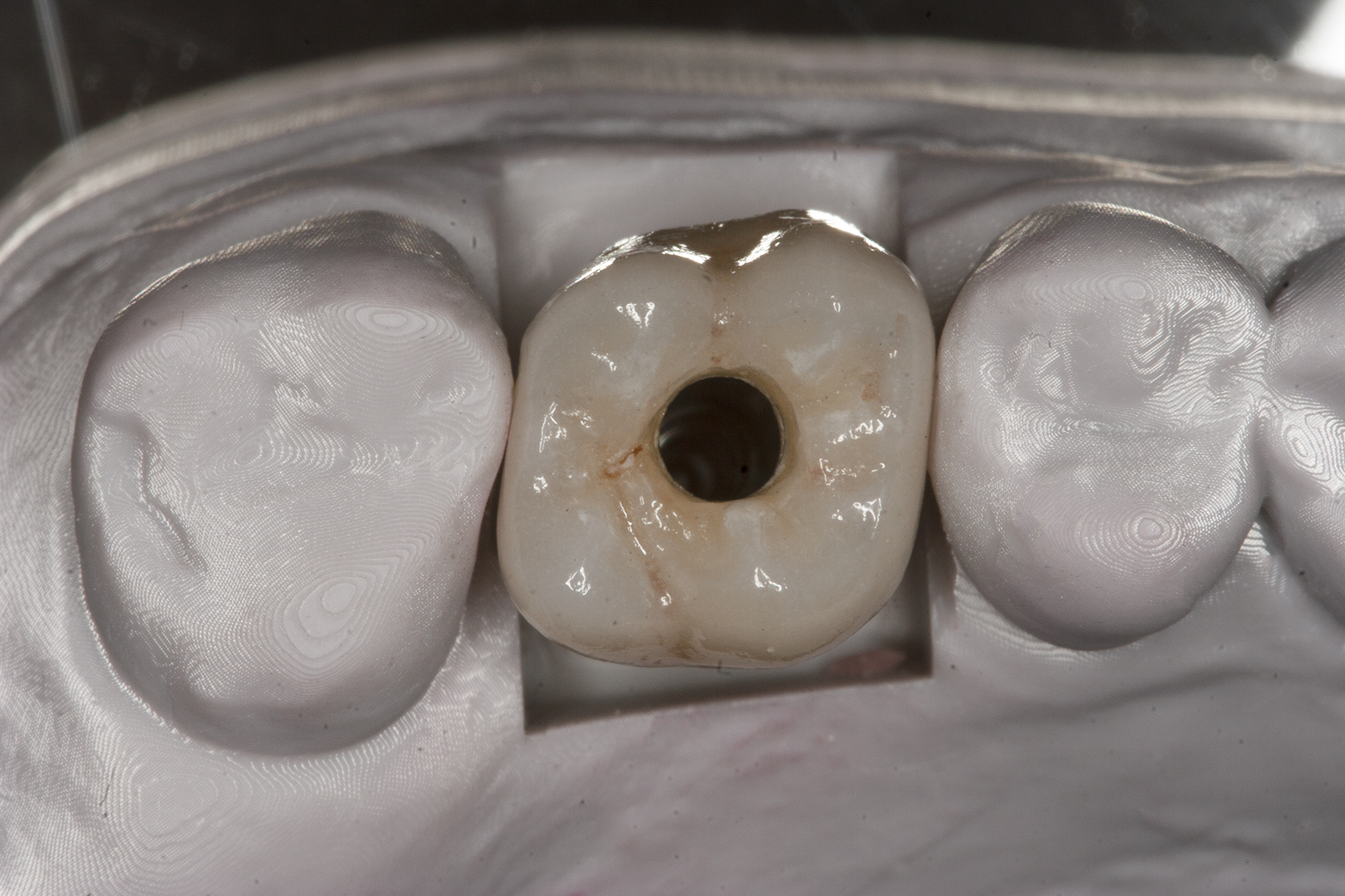 Implant crown on printed cast occlusal view
